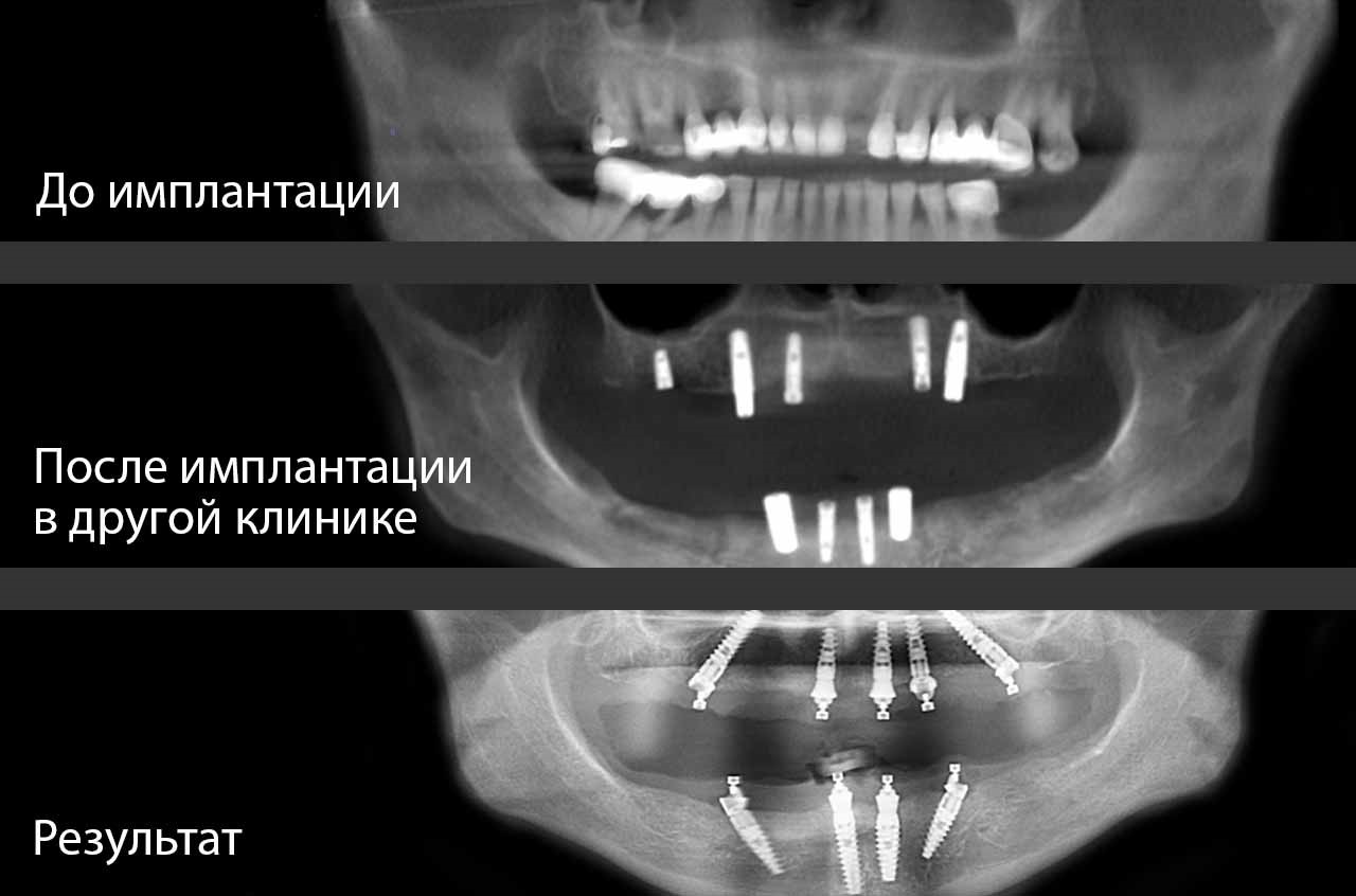 импланты фото до и после