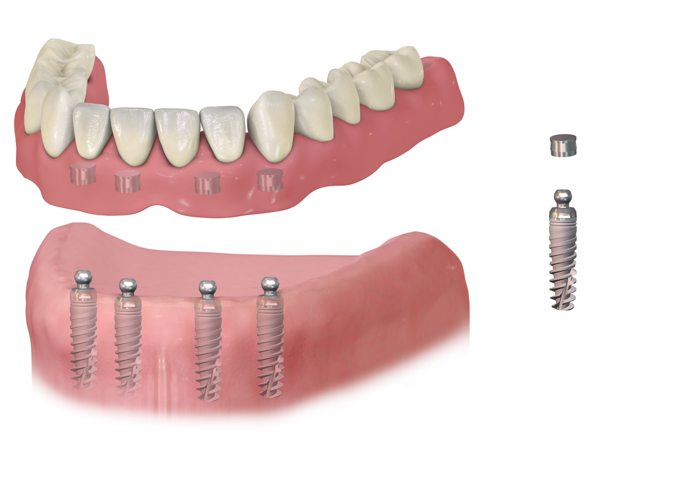 Льготы на протезирование зубов: кому положены и как их получить