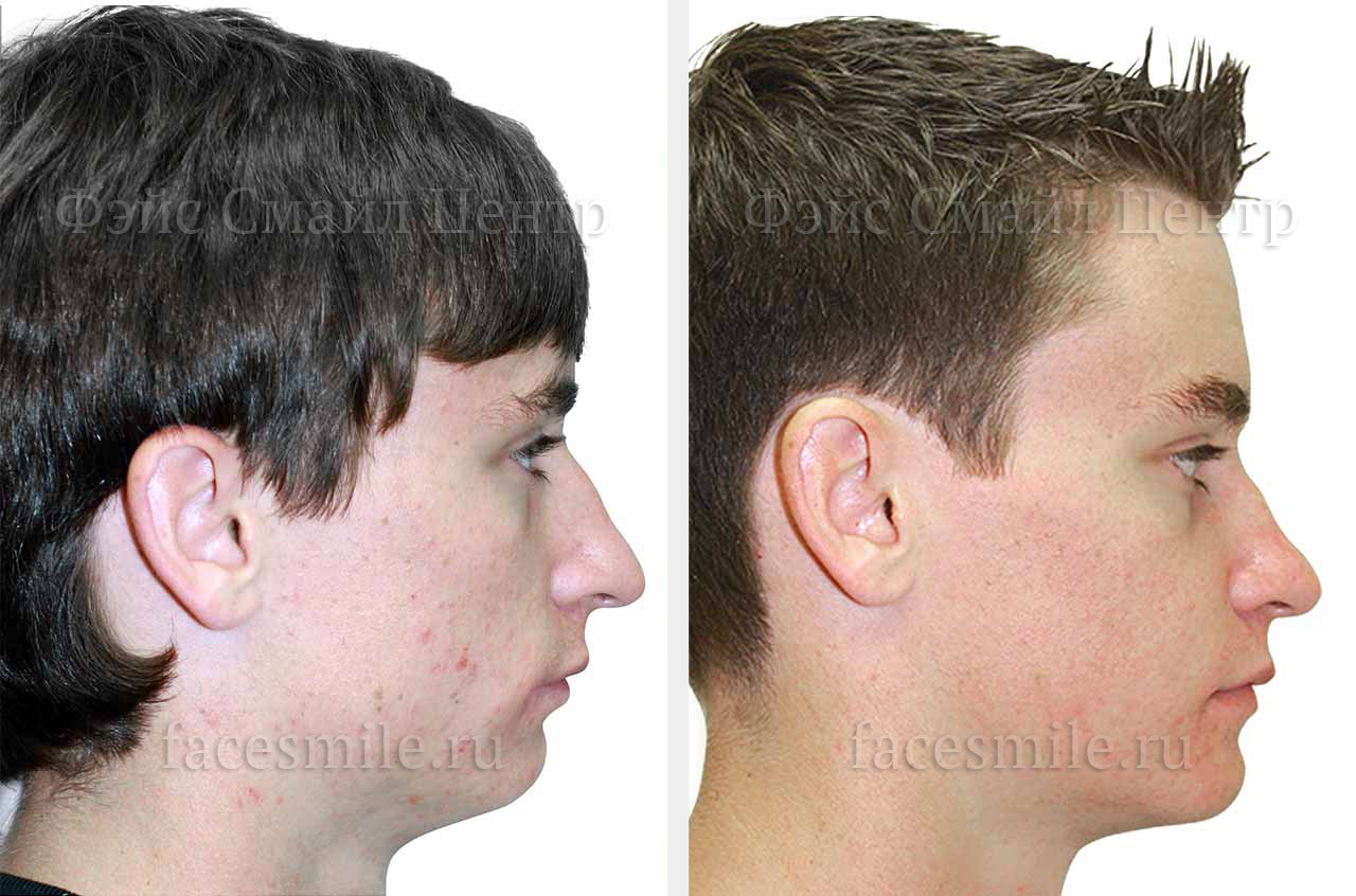 Коррекция прикуса и асимметрии лица до и после ортогнатической операции фото пациента в анфас без улыбки