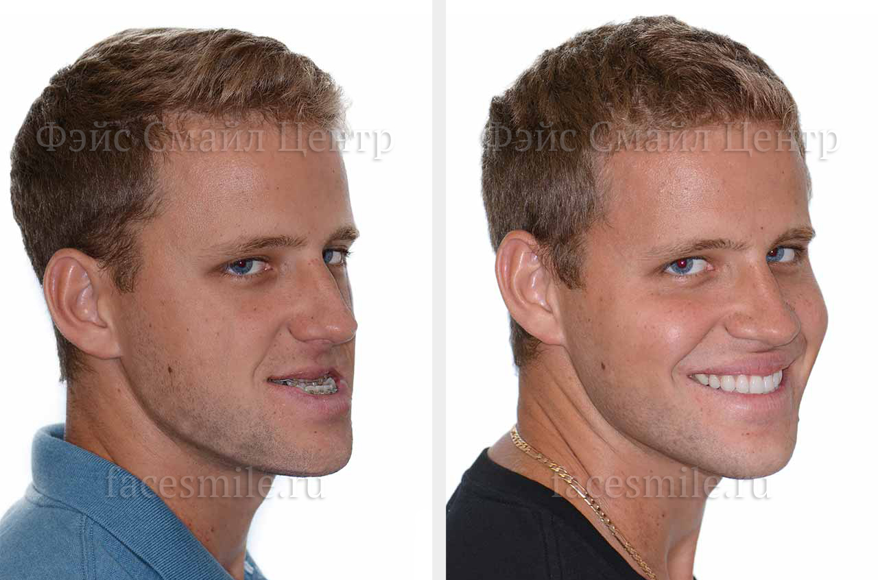 Фото пациента до и после ортогнатической операции в три четверти оборота с улыбкой