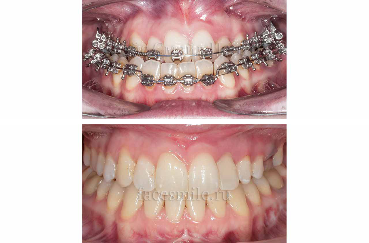 Corrective jaw surgery and bite correction front view with smile