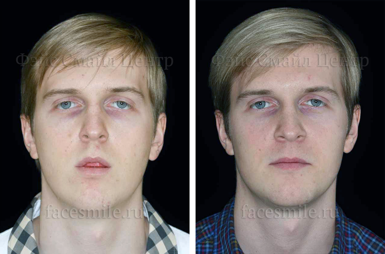Собчак операция на челюсти фото до и после