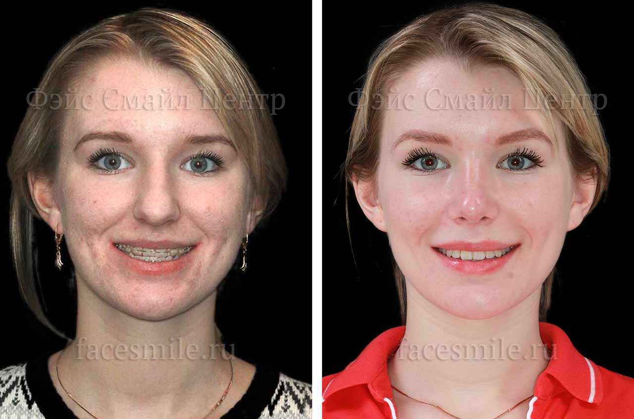 Контурирование тела нижней челюсти, фронтальное фото До и После без улыбки