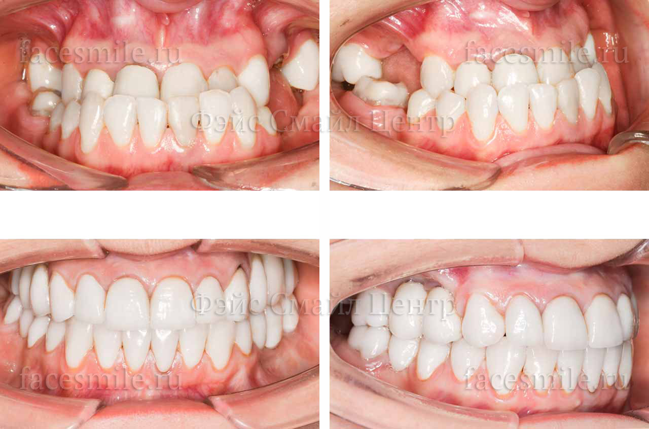 Коррекция прикуса, фото зубов До и После
