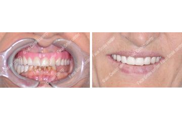 CT-Scan до и после имплантации зубов по методике все на четырех в клинике Фэйс Смайл центр в г.Москва